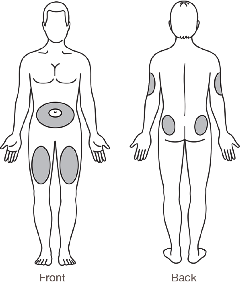 Where to inject insulin lispro. Injection sites include the stomach area, buttocks, upper legs, and upper arms.